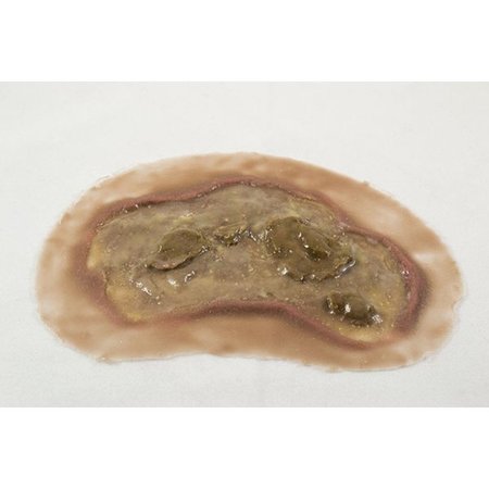 MOULAGE SCIENCE & TRAINING Large Ulcer, Dark w/Odor, PK 12 MST-45-04-O12